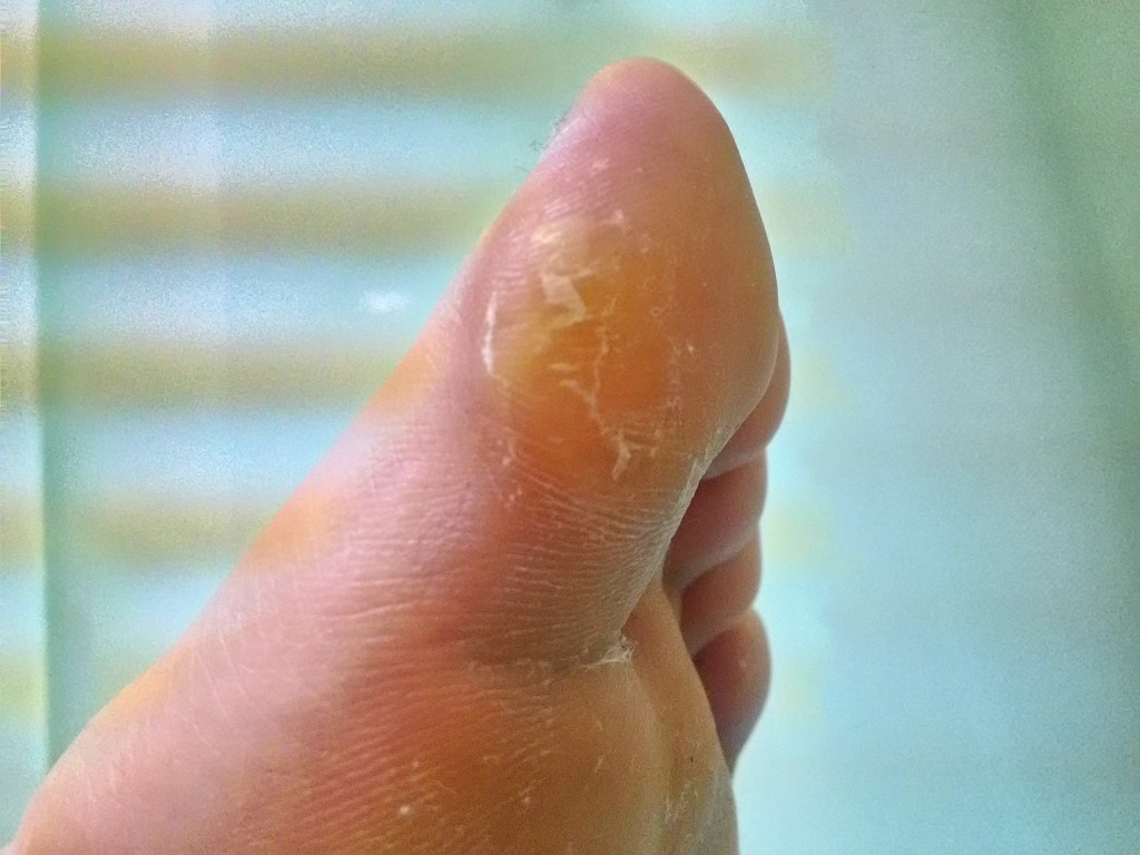 足 の 親指 タコ 痛い